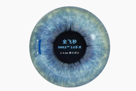 全飛秒近視眼手術(shù)后多久能打球 全飛秒近視眼手術(shù)后多久能打球