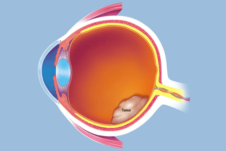 撅眼最快的治療方法是什么 需要如何防止復(fù)發(fā)？