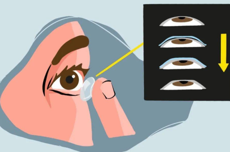 嬰兒也會得白內障真的假的？